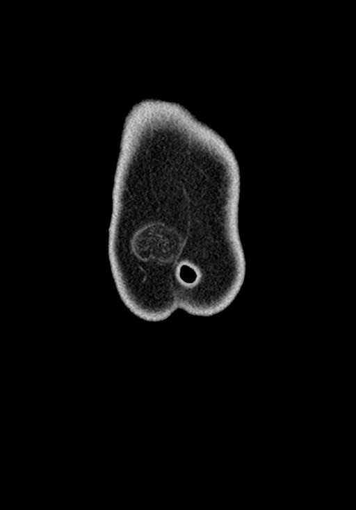 Adhesional small bowel obstruction (Radiopaedia 58900-66131 Coronal C+ portal venous phase 43).jpg