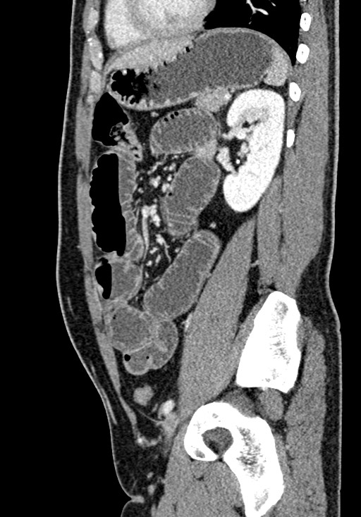 Adhesional small bowel obstruction (Radiopaedia 58900-66131 Sagittal C+ portal venous phase 169).jpg