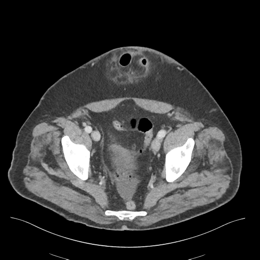 File:Adhesions within abdominal wall hernia (Radiopaedia 58283-65394 Axial C+ portal venous phase 73).png