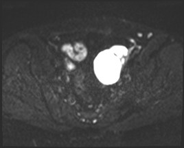 Adnexal multilocular cyst (O-RADS US 3- O-RADS MRI 3) (Radiopaedia 87426-103754 Axial DWI 11).jpg