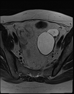 File:Adnexal multilocular cyst (O-RADS US 3. O-RADS MRI 3) (Radiopaedia 87426-103754 Axial 2).jpeg