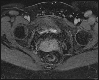 File:Adnexal multilocular cyst (O-RADS US 3. O-RADS MRI 3) (Radiopaedia 87426-103754 Axial 240).jpeg