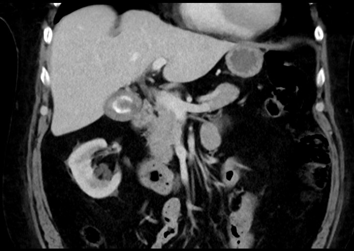 Adrenal cortical carcinoma (Radiopaedia 64017-72769 Coronal C+ portal venous phase 21).jpg