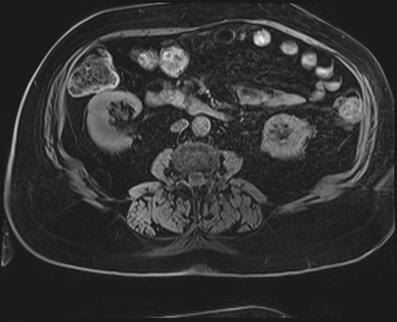Adrenal cortical carcinoma (Radiopaedia 64017-72770 Axial T1 C+ fat sat 34).jpg