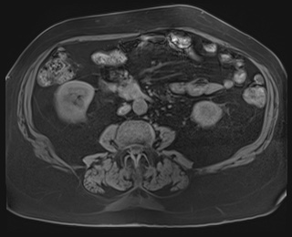 Adrenal cortical carcinoma (Radiopaedia 64017-72770 Axial T1 fat sat 57).jpg