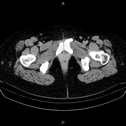 Adrenal cortical carcinoma (Radiopaedia 84882-100379 Axial C+ delayed 100).jpg