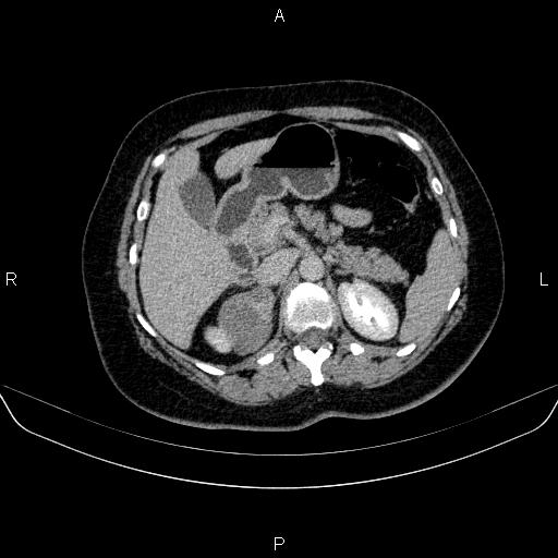 Adrenal cortical carcinoma (Radiopaedia 84882-100379 Axial C+ delayed 27).jpg