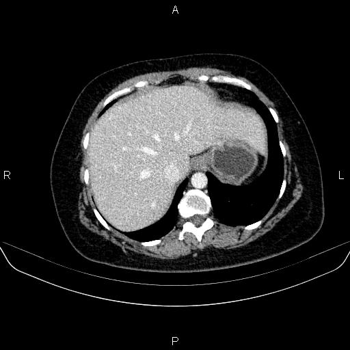 Adrenal cortical carcinoma (Radiopaedia 84882-100379 Axial C+ portal venous phase 13).jpg