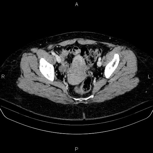 Adrenal cortical carcinoma (Radiopaedia 84882-100379 Axial C+ portal venous phase 85).jpg