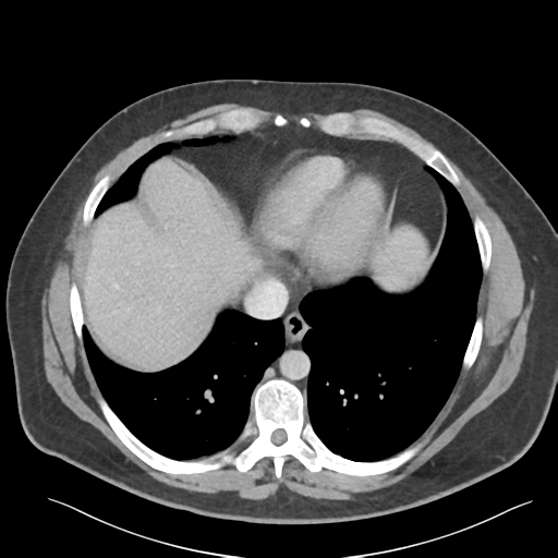 File:Adrenal cyst (Radiopaedia 45625-49777 Axial C+ portal venous phase 14).png
