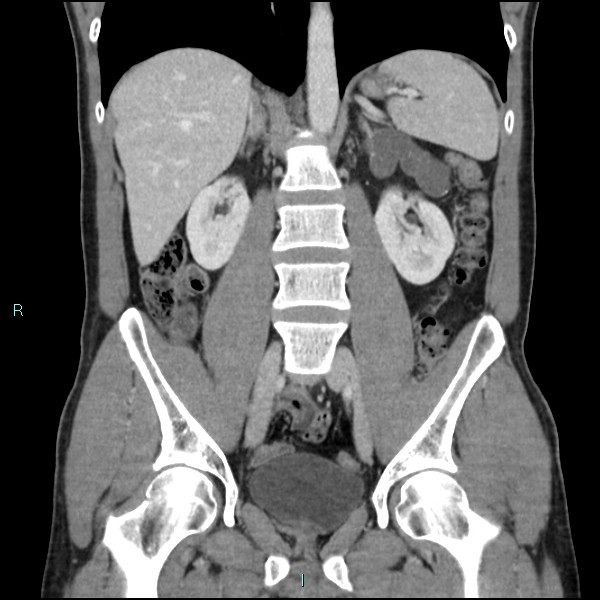 Adrenal cystic lymphangioma (Radiopaedia 83161-97534 Coronal C+ portal venous phase 43).jpg