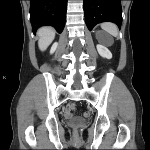 Adrenal cystic lymphangioma (Radiopaedia 83161-97534 Coronal C+ portal venous phase 55).jpg