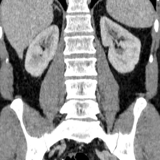 File:Adrenal glands (normal CT anatomy) (Radiopaedia 16570-105725 Coronal 17).jpg
