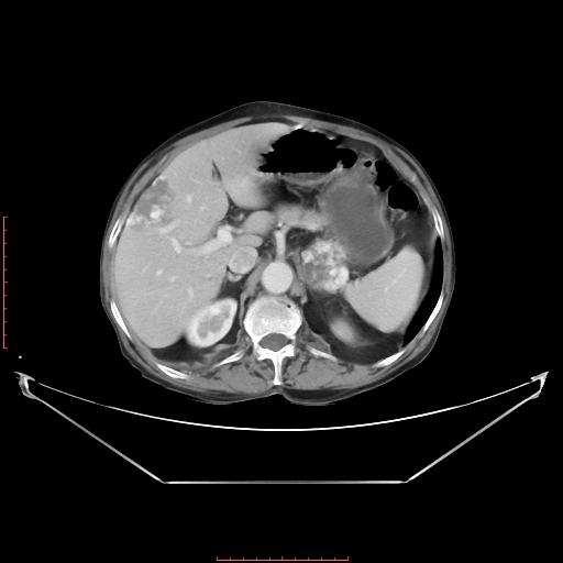 Adrenal hemangioma (Radiopaedia 68923-78668 Axial C+ portal venous phase 24).jpg