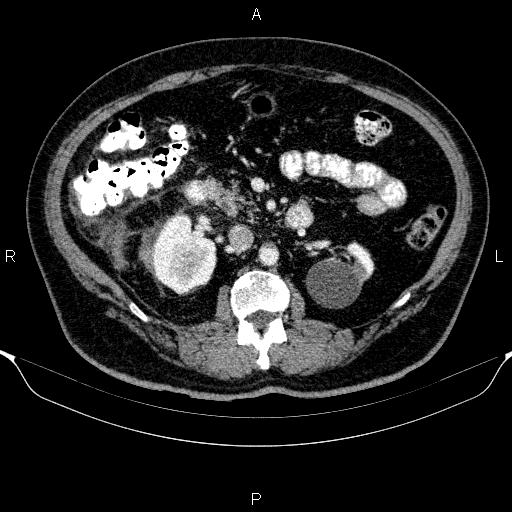 Adrenal hemorrhage (Radiopaedia 62622-70916 Axial C+ portal venous phase 79).jpg