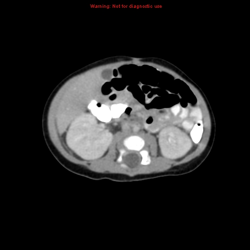 File:Adrenal hemorrhage (Radiopaedia 9390-10077 Axial C+ portal venous phase 17).jpg