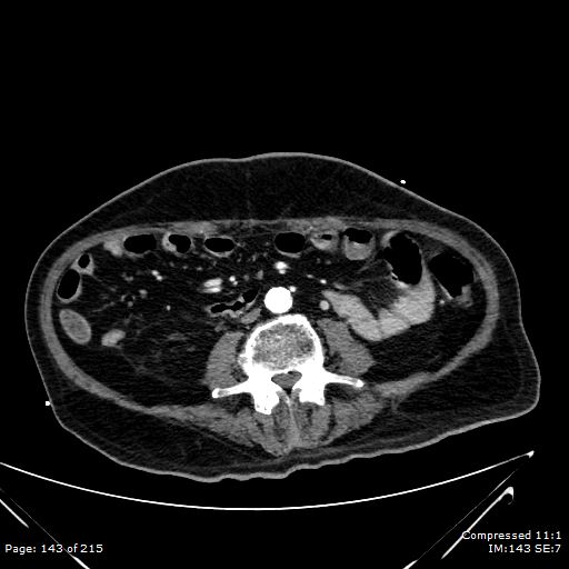 Adrenal metastasis (Radiopaedia 78425-91079 Axial C+ arterial phase 73).jpg