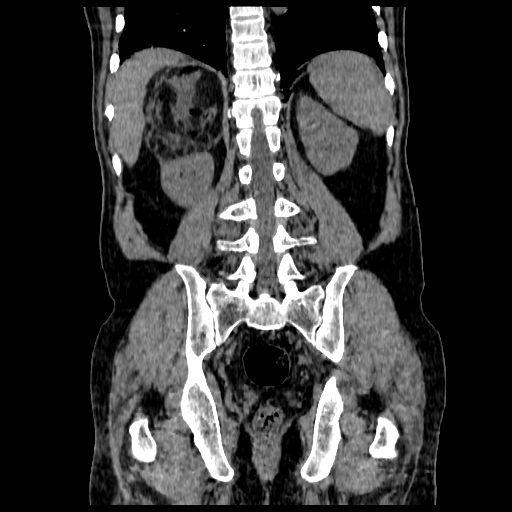 File:Adrenal myelolipoma (Radiopaedia 41843-44834 Coronal non-contrast 16).jpg