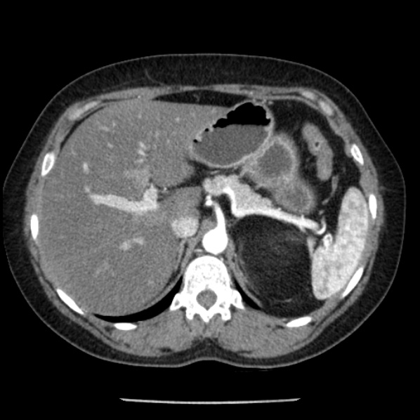 Adrenal myelolipoma (Radiopaedia 43401-46759 Axial C+ arterial phase 25).jpg