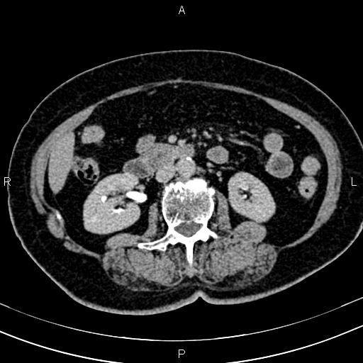 Adrenal myelolipoma (Radiopaedia 82742-96986 Axial renal excretory phase 71).jpg