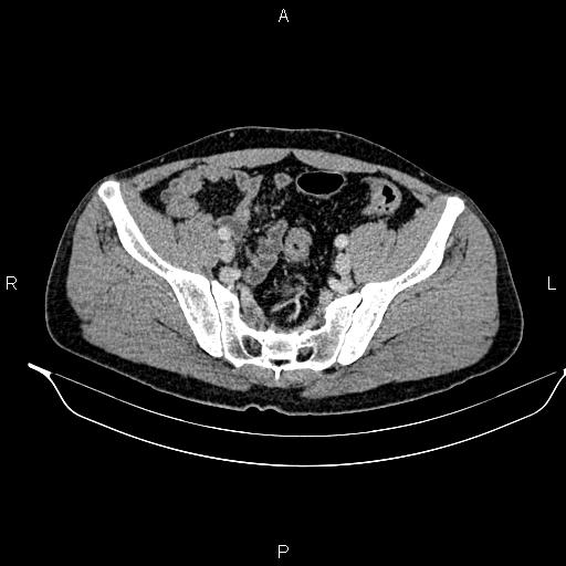 Adrenal myelolipoma (Radiopaedia 87794-104246 Axial renal cortical phase 86).jpg