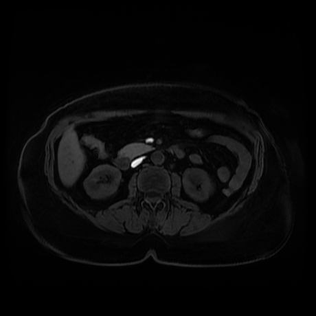 Adrenal myelolipoma - MRI (Radiopaedia 83249-97646 Axial T1 fat sat 49).jpg