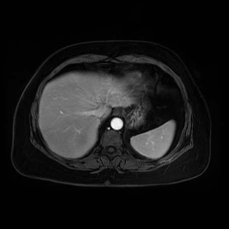 Adrenal myelolipoma - MRI (Radiopaedia 83249-97646 T1 fat sat arterial phase 9).jpg
