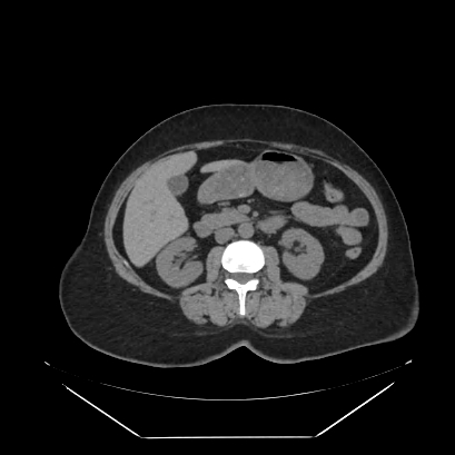 Adrenal myelolipoma - MRI (Radiopaedia 83249-97647 Axial non-contrast 66).jpg