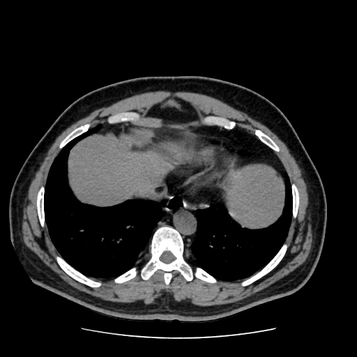 Adrenal myelolipoma and beaver tail liver (Radiopaedia 86201-102193 Axial non-contrast 33).jpg