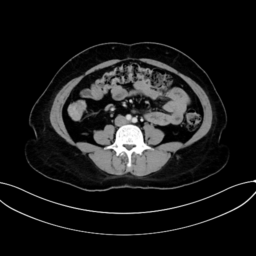 Adrenocortical carcinoma (Radiopaedia 87281-103569 Axial C+ portal venous phase 52).jpg