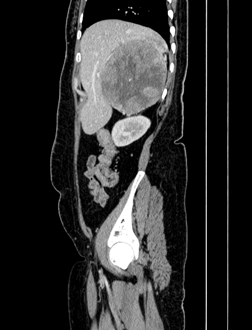 Adrenocortical carcinoma (Radiopaedia 87281-103569 Sagittal C+ portal venous phase 55).jpg