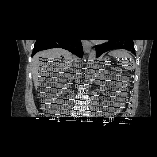 Adult polycystic kidney disease (Radiopaedia 59075-66368 Axial non-contrast 1).jpg