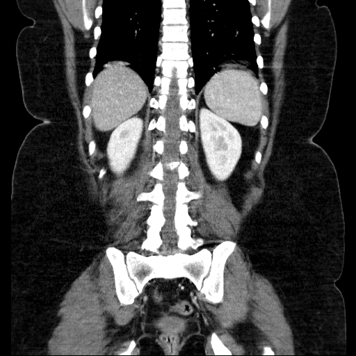 File:Afferent loop syndrome - secondary to incarcerated trocar site hernia (Radiopaedia 82959-97305 Coronal C+ portal venous phase 110).jpg