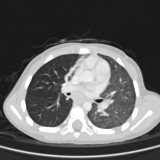 Airway foreign body (Radiopaedia 72128-82638 Axial lung window 41).jpg