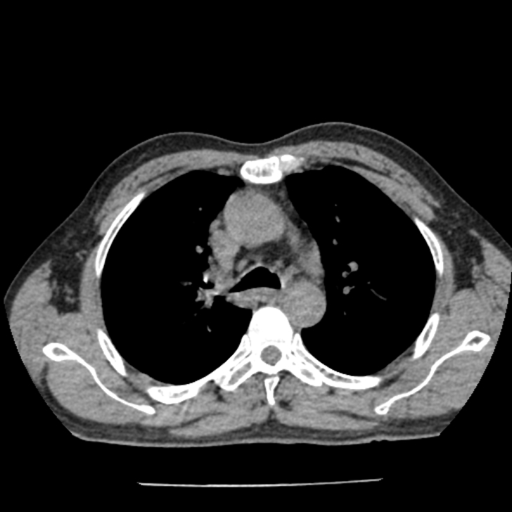 Airway foreign body in adult (Radiopaedia 85907-101779 Axial liver window 51).jpg