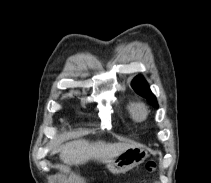 Airway foreign body in adult (Radiopaedia 85907-101779 Coronal liver window 16).jpg
