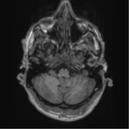 File:Alzheimer's disease- with apraxia (Radiopaedia 54763-61011 Axial T1 15).png