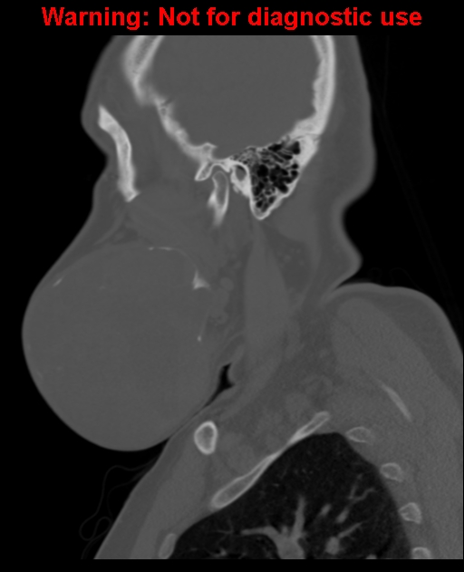 Ameloblastoma (Radiopaedia 33126-34164 Sagittal bone window 21).jpg