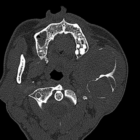 Ameloblastoma (Radiopaedia 51921-57766 Axial bone window 104).jpg
