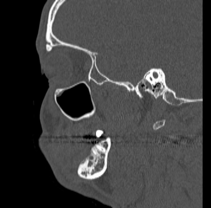 Ameloblastoma (Radiopaedia 77750-89997 Sagittal bone window 62).jpg