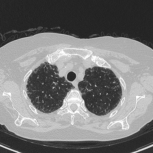File:Amiodarone-induced pulmonary fibrosis (Radiopaedia 82355-96460 Axial lung window 14).jpg