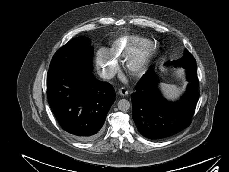 Amiodarone lung (Radiopaedia 62514-70769 Axial non-contrast 65).jpg