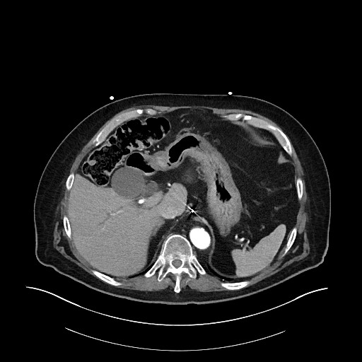 Ampullary adenocarcinoma (Radiopaedia 59373-66734 A 43).jpg