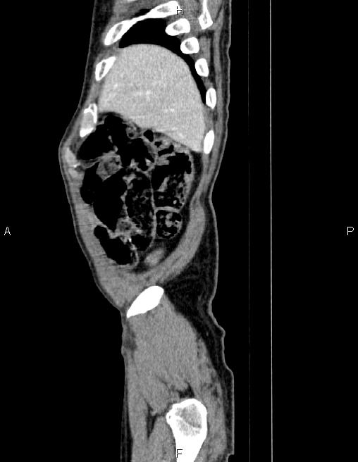 Ampullary adenocarcinoma (Radiopaedia 86093-102032 D 6).jpg