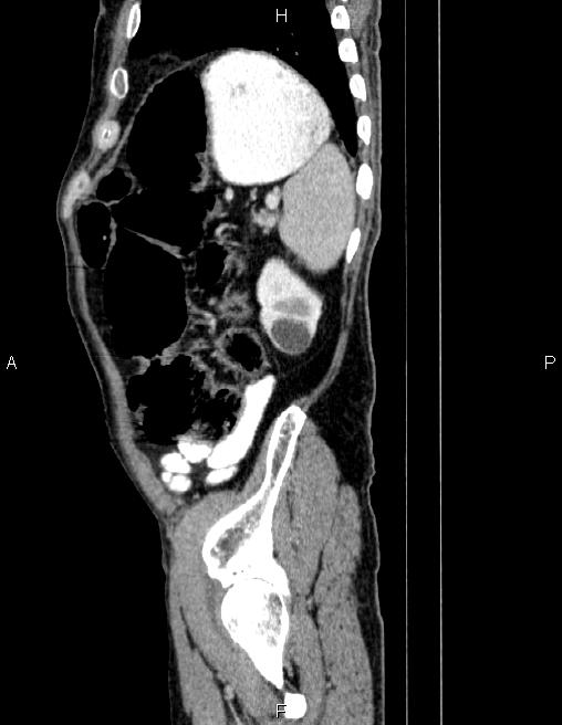 Ampullary adenocarcinoma (Radiopaedia 86093-102032 D 81).jpg