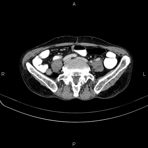 Ampullary adenocarcinoma (Radiopaedia 86093-102033 B 86).jpg