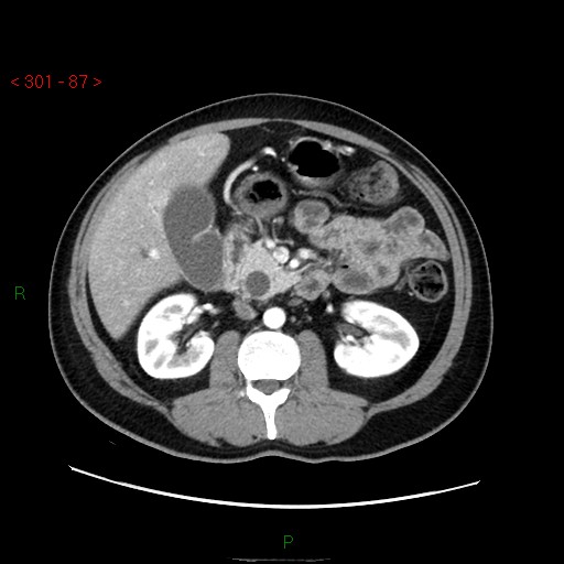 File:Ampullary carcinoma (Radiopaedia 56396-63056 B 33).jpg