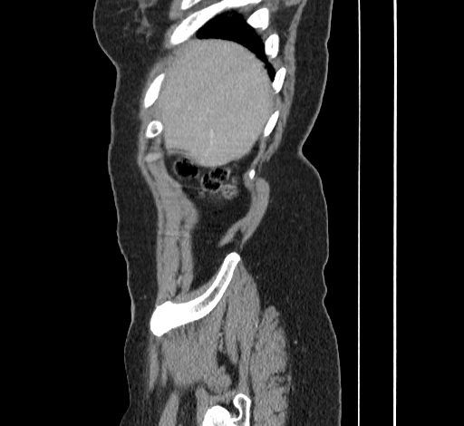 Ampullary tumor (Radiopaedia 60333-67998 C 3).jpg