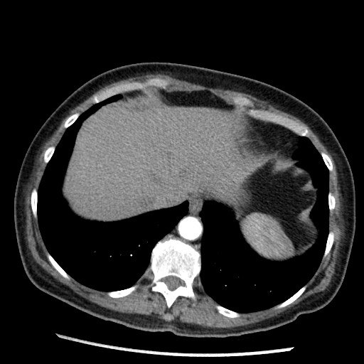 File:Amyloidosis - bronchial and diffuse nodular pulmonary involvement (Radiopaedia 60156-67745 A 45).jpg