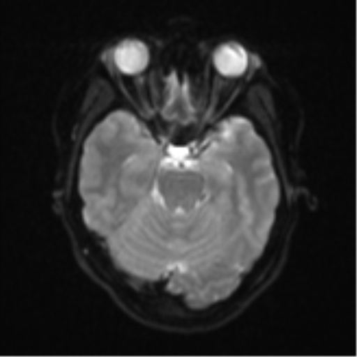Anaplastic astroblastoma (Radiopaedia 55666-62194 Axial DWI 10).png